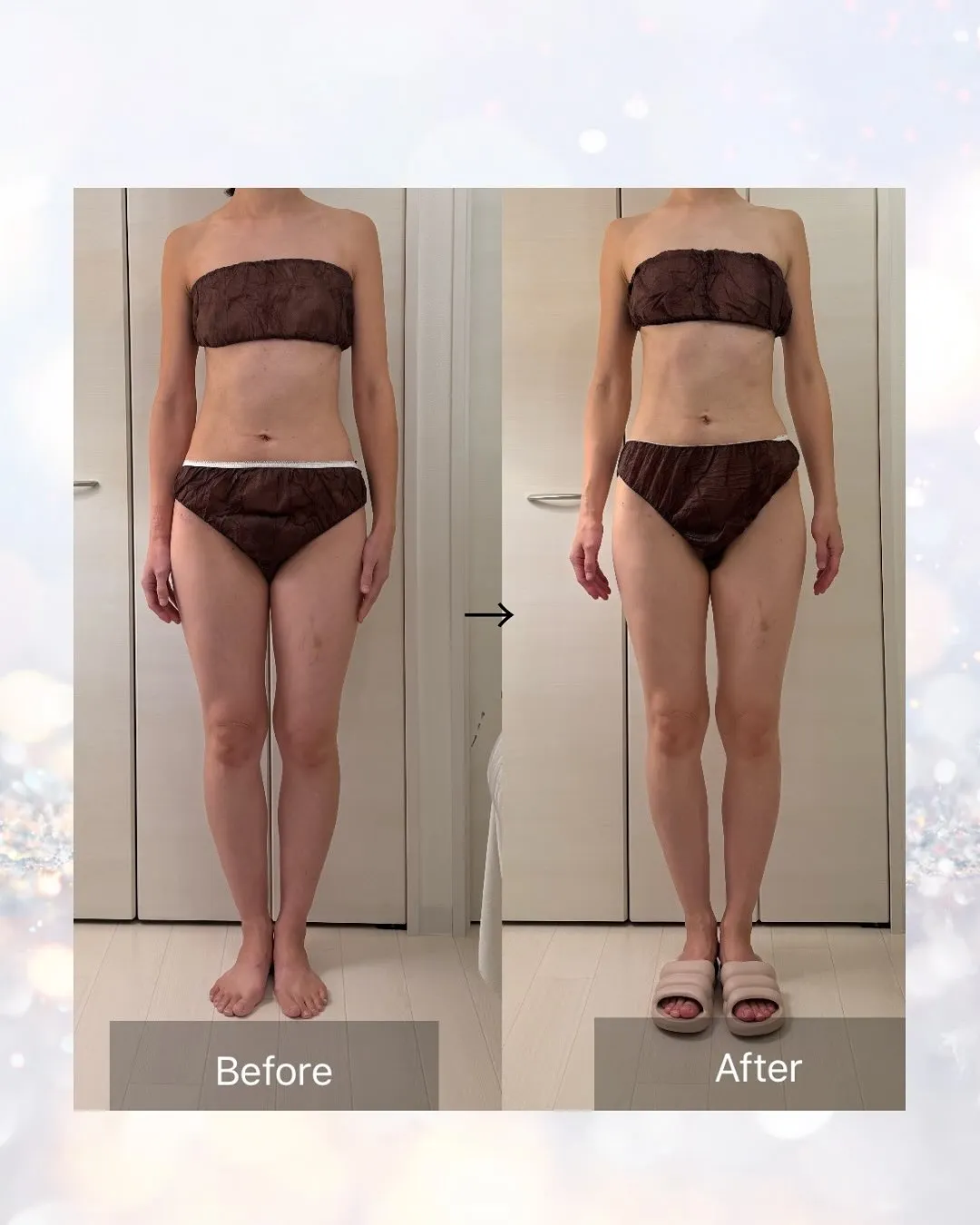 インディバ施術のビフォーアフターをご紹介します✨