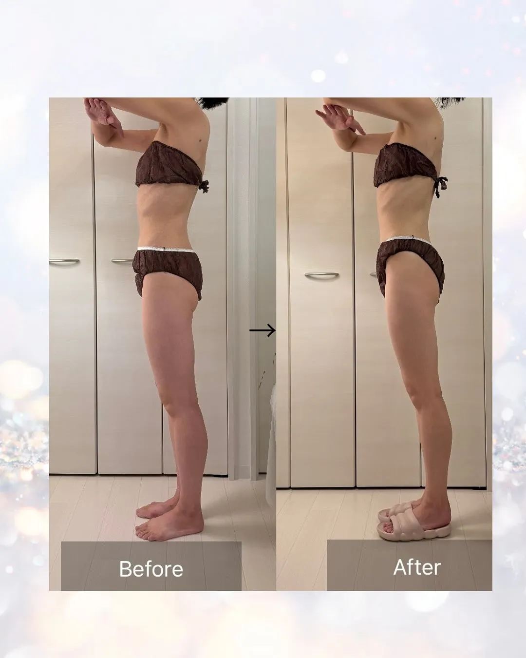 インディバ施術のビフォーアフターをご紹介します✨